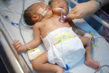 A nurse checks the vital signs of conjoined twins in Manila on July 29, 2009. Doctors at Manila's Jose Fabella Memorial Hospital were trying to save the baby girl born with two