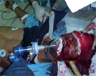 أحد ضحايا القمع في تعز (الجزيرة نت)