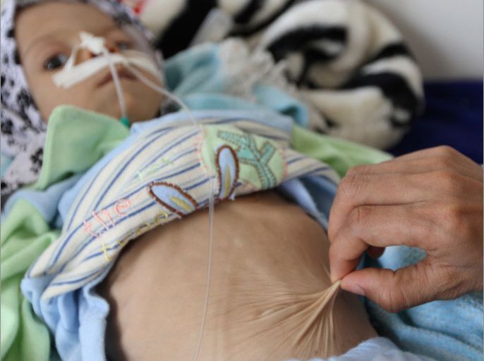 A woman pinches her malnourished child at a therapeutic feeding center at al-Sabyeen hospital in Sanaa May 28, 2012. REUTERS/Mohamed al-Sayaghi (YEMEN - Tags: HEALTH SOCIETY POVERTY)