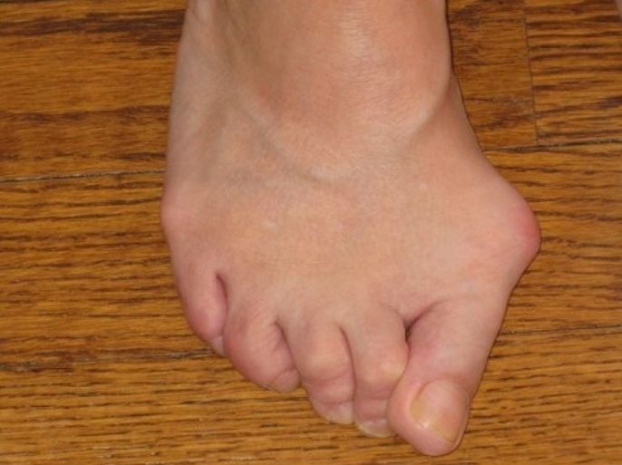 Typical Bunion Bone Deformity - Pre-Foot Surgery - Patient Suffered 20 Years Prior to Bunion Correction By Dr. Neufeld, Ludloff Plate Technique.