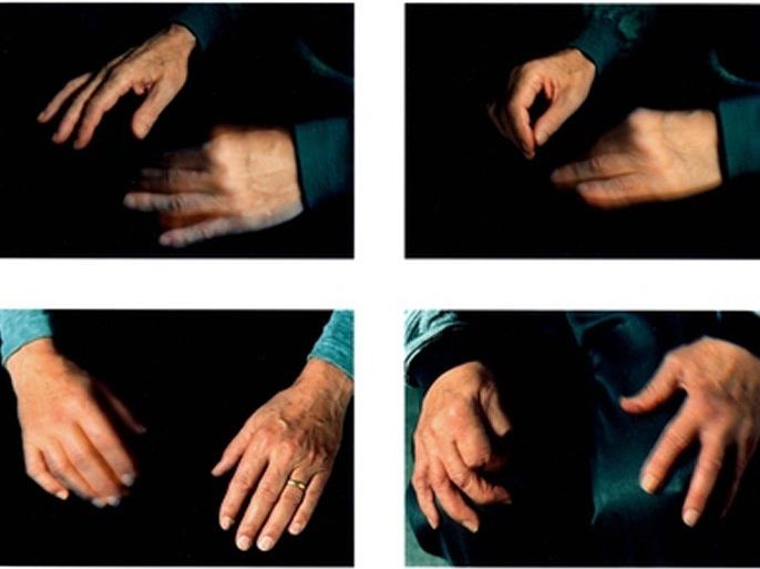 ارتعاش اليدين بمعدل 4 إلى 6 حركات في الثانية مؤشر على الإصابة بالباركنسون