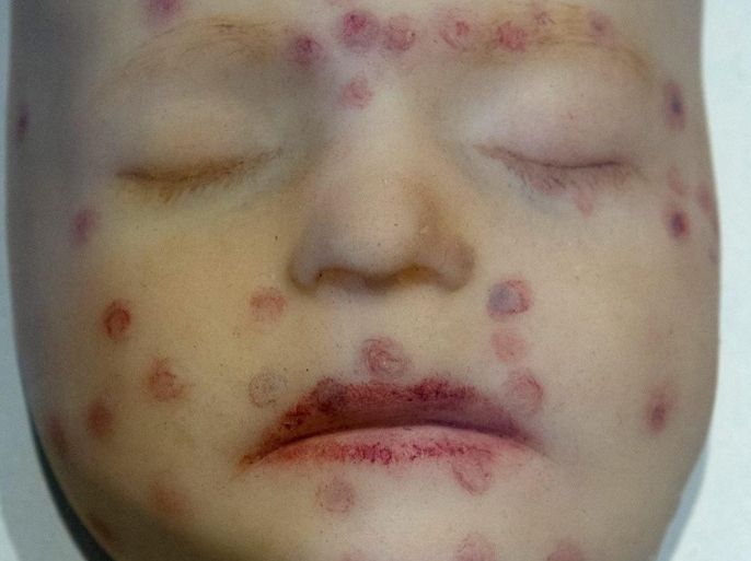 A wax model of a face with signs of Syphilis is on display in the exhibition 'MenschMikrobe' (lit.: Human Microbe) at the Alfried-Krupp-Wissenschaftskolleg in Greifswald, Germany, 15 January 2013. The traveling exhibition about the challenges that infections pose for society from the German Research Society and the Robert Koch Institute opens in Greifswald on 18 January.