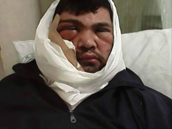 مهند إبراهيم بعد إصابته بجرثومة المستشفى (الجزيرة)