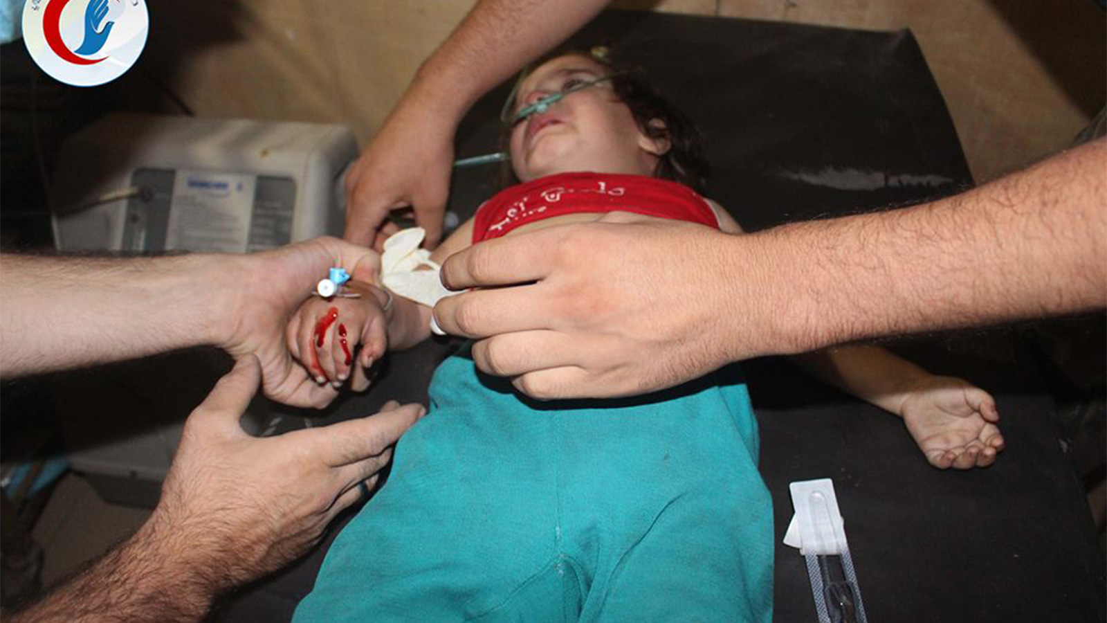 ‪طفلة أصيبت بحالة اختناق جراء قصف حي جوبر‬ (ناشطون)