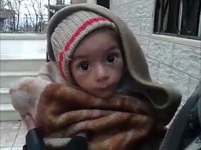طفل يعاني نقص التغذية جراء حصار بلدة مضايا