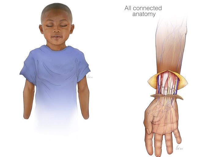 A handout illustration made available on 29 July 2015 by the Childrens Hospital of Philadelphia showing eight-year-old Zion Harvey before and after a bilateral hand transplant earlier this month at Children's Hospital of Philadelphia in Philadelphia, Pennsylvania, USA, 28 July 2015. Harvey, who lost his hands and feet due to an infection when he was two, had his hands replaced in an 11-hour operation performed by a 40-person team at the hospital that was only revealed this week. EPA/CHILDREN'S HOSPITAL OF PHILADELPHIA / HANDOUT
