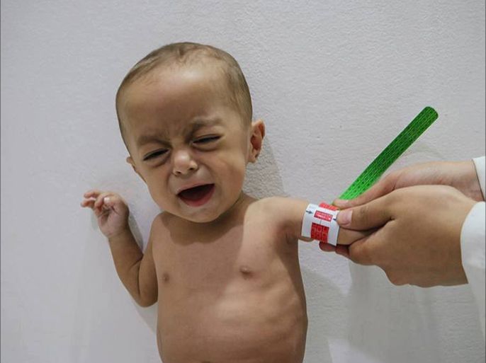 من حالات سوء التغذية في الغوطة - الصورة من مركز الحكيم