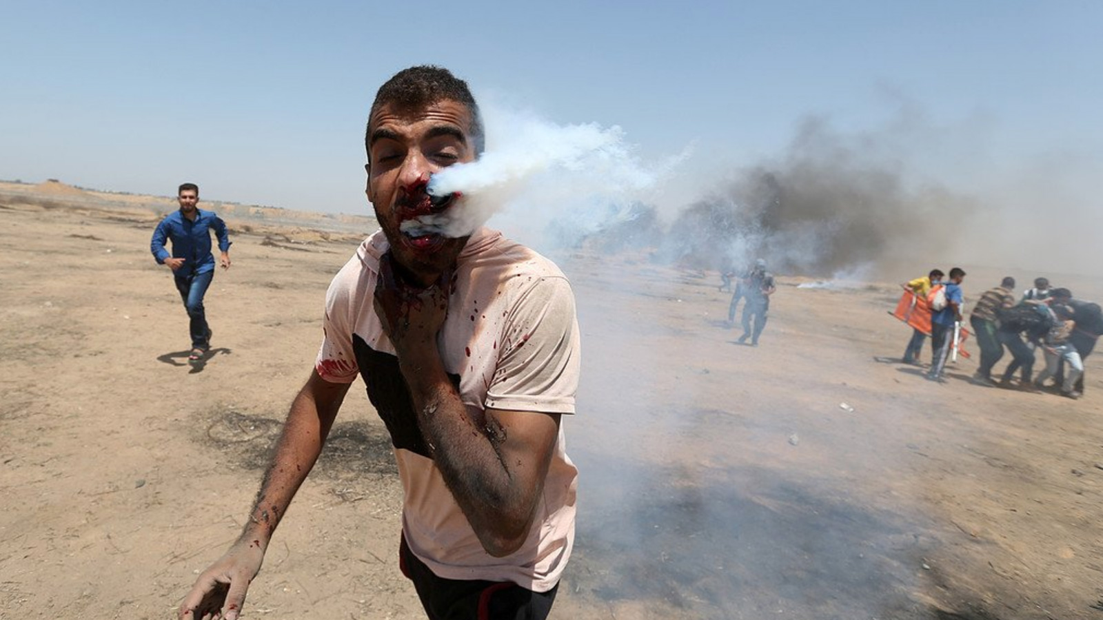 إصابة شاب بقنبلة غاز في فمه أطلقها جنود الاحتلال على المتظاهرين السلميين (التواصل الاجتماعي)