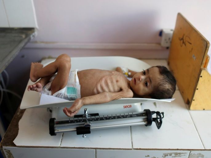 A malnourished child lies on a weighing scale at the malnutrition ward of al-Sabeen hospital in Sanaa, Yemen September 11, 2018. Picture taken September 11, 2018. REUTERS/Khaled Abdullah