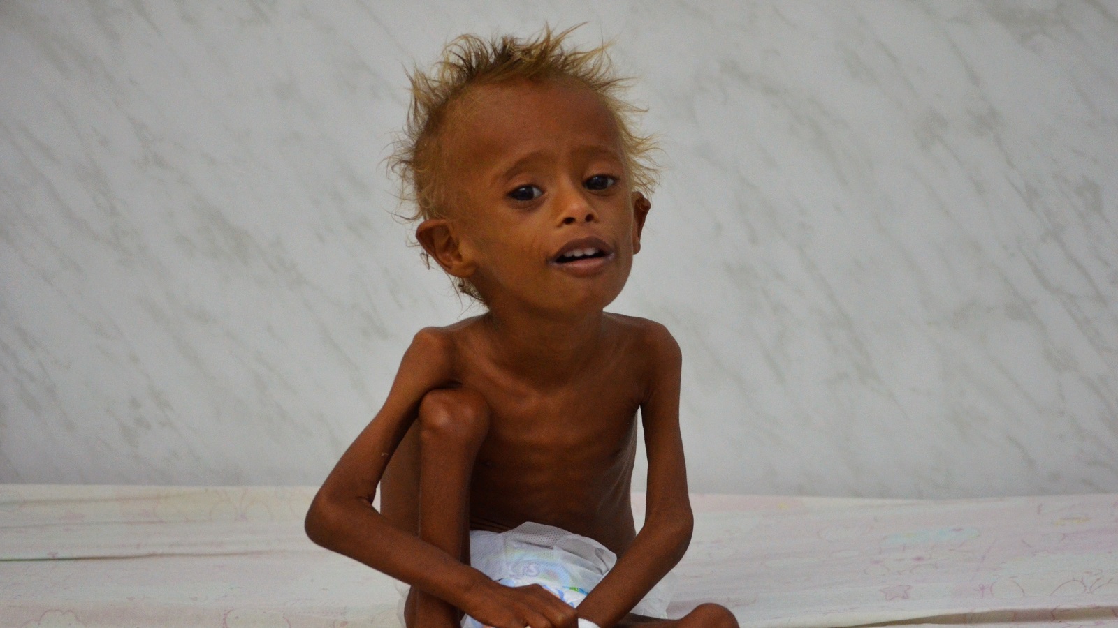 ‪(رويترز)‬ نحو 1.5 مليون طفل في اليمن يعانون من سوء التغذية الحاد