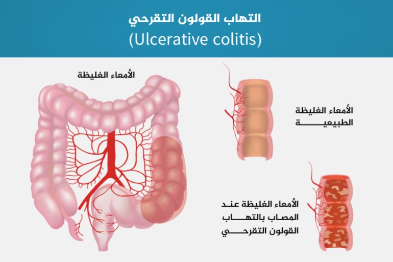 التهاب القولون التقرحي أمعاء قولون الأمعاء الغليظة (Ulcerative colitis)