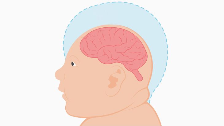 طفل مصاب بالصعل، Microcephaly
