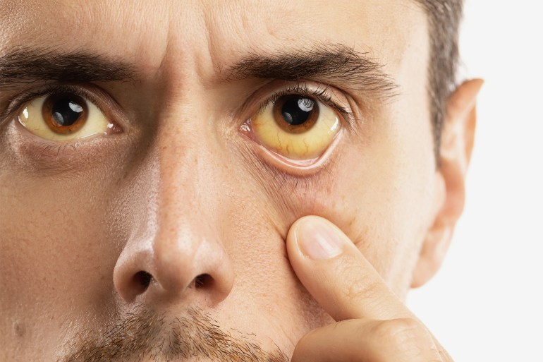 Man checking his health condition. Yellowish eyes is sign of problems with liver, viral infection or other disease_