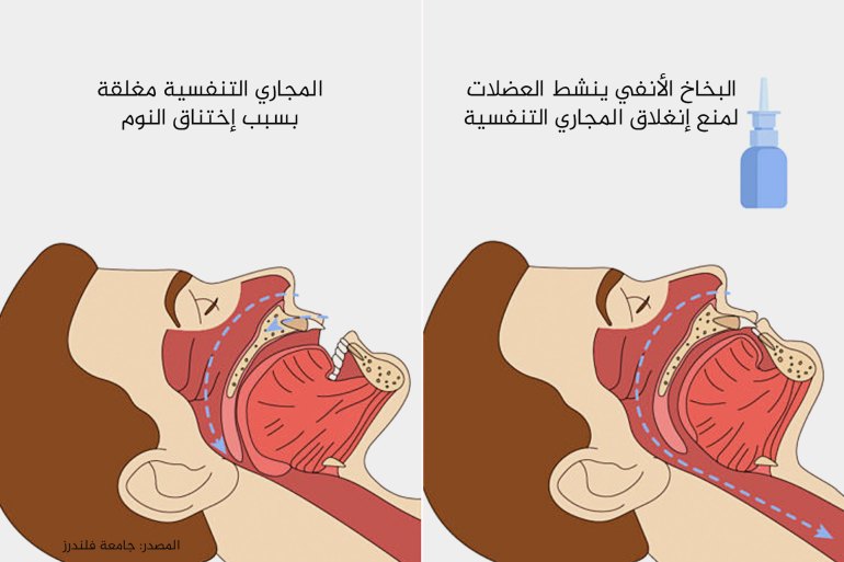 Sleep apnea solution could be right under your nose